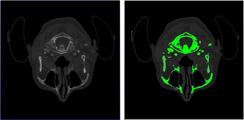 Figure 11: Snap shooting of CT-data representation in 3D mode. (a) Mapping in grayscale voxel model. (b) Mapping in MIP algorithm method In case of 3D voxel visualization, the object is represented as a set of voxels. The 3D model is performed using3D raster visualization. The additional characteristic of voxel is that it expresses the transparency degree. This visualization can be carried out using partial slices through alteration of the transparency degree of voxels for different objects; taking into account of the transparent voxel objects should be removed. Current visualization method could estimate the spatial relationships between the vessels and surrounding structures (Figure 11a).