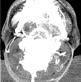 Figure 14: The risk of neurosurgical access. (a) Geometric representation. (b) Graphical representation Conclusion and Future Work The study reached the following conclusions: • The (Risk Map) of brain structures is an effective approach to the definition of the risk of surgical approach. • The choice of surgical approach should take into account the geometry of the surgical instrument track, as well as the errors of the stereotactic navigation system; • The accuracy of the navigation system must be much higher than to make the decision of surgery depending on the simulation systems only (Interactive with the user); • The choice of surgical approach should take into account the possible brain structures displacement, in accordance with the type of trepanation. • A promising direction for further researching this area is the implementation of these descriptive approaches in a computer system planning neurosurgery. It is also necessary to determine the optimal surgical approaches, taking into account which will allow determining the trajectory, including a minimum with broad flat areas. • The significance of the current study also relies in the advances of computer aided design applications for obtaining and displaying more diagnostic information to be used in neurosurgical planning systems. Increasing of data obtaining and diagnostic significance, using the method of CT contrast-data, can be achieved via developing and improving data visualization algorithms. Therefore, one of the main parts of the CT contrast-data visualization system is the subsystem of secondary processing data and display unit. • The display methods of the vascular system data, using CT contrast-data, are divided into 2D and 3D models. The first algorithm has a relatively low visibility, but allows accurate measurements of the anatomical- structure parameters. The most effectivemethodof2Dvisualization is the display mode in 2.5Dassociated with using structures containing more data about the anatomical objects. The3D model is designed for virtual examination of spatial relationships between anatomical structures as well as 3D visualization of the vascular channel. • Our current algorithms develop appropriate software allowing a proper visualization the vascular system of the brain in different modes with scanning increments of1 mm, confirmed via testing the results of the work in the diagnostic center of Kharkov regional clinical hospital. The significance of the current research is the development of algorithms for automatic identification of vascular system, obtaining and displaying more diagnostic data of neurosurgical planning systems. • finally, ratification: all the functions of selecting surgical access is observed and completely controlled by the user