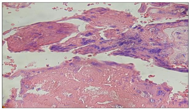 Figure 4: Region stromal of stem villi is transformed in fibrinoid.400x.H&E.