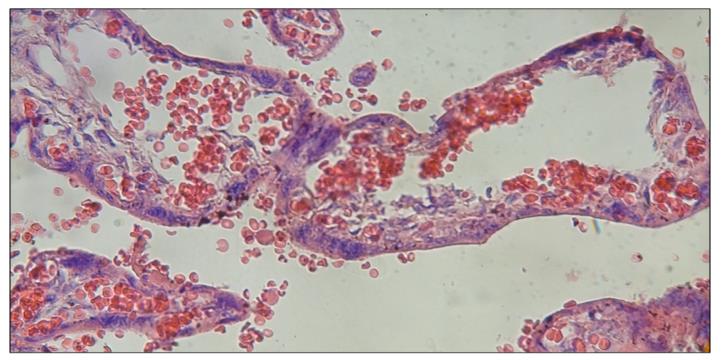 Figure 5: Empty stromal region in stem villi shows erithrocytes only.400x.H&E.