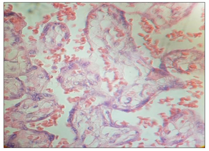 Figure 6: Several villi with stromal region disarranged are shown. 400x. H&E.