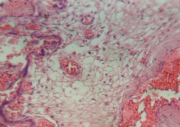 Figure 8: Syncytial nuclear necrosis and interrumped channels in the stromal region of immature intermediate villi can be seen.400x.H&E.
