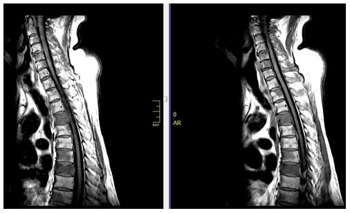 Figure 10: T1 weighted sagittal images of dorsal spine performed with the 0.35 Tesla Magnetom-C (SIEMENS) machine. Which showing metastatic lesion at multiple levels of dorsal spine.