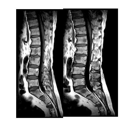 Figure 11: T2 weighted (Left) & T2 STIR weighted sagittal images of dorsal spine performed with the 0.35 Tesla Magnetom-C (SIEMENS) machine, which showing metastatic lesion at multiple levels of dorsal spine.