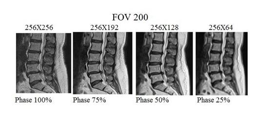 Figure 6: T1 weighted sagittal images performed with the 1.5 Tesla Achieva (Philips) machines, which showing only disc bulges and single lesion at L2V, but not clear.