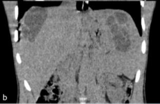 Figure 4: Abdominal MRI in axial T2-weighted (a) and three-dimensional reconstruction T2-weighted (b) sequences: giant splenic HC, Gharbi type 1 (univesicular) with T2 hypersignal, T1 hyposignal, and the characteristic appearance of T2 hyposignal of the cyst own membrane.