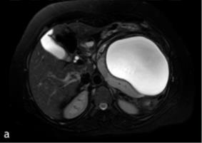 Figure 6: Postoperative aspect of a total splenectomy carrying hydatid cyst.