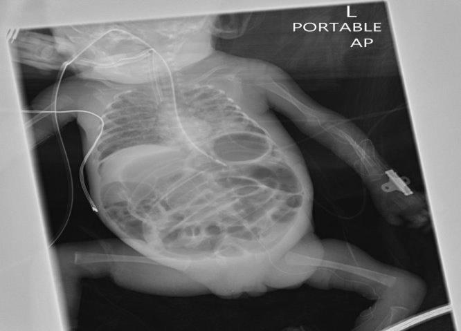 Figure 2: Abdomen X-ray (AP view) showed generalized abdominal distension, and pneumatosis intestinalis.