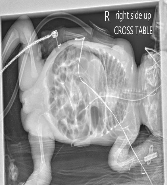 Figure 3: Abdomen X-ray, left lateral view showed air above the liver which indicate pneumoperitoneum.