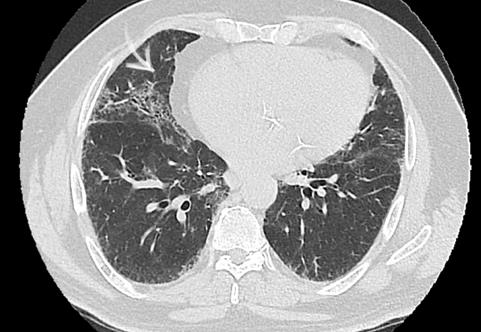 Figure 1: Chest X ray AP projection