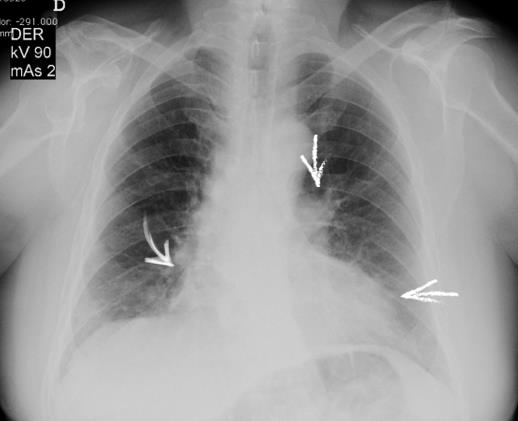 Figure 2: Axial reconstruction showing areas of ground glass in the peripheral lung tissue without interlobulillar septal thickening (arrows).