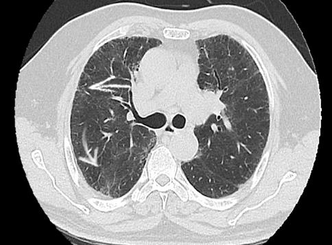 Figure 3: Axial reconstruction with areas of consolidation in the below segment of the lingual (straight arrow).