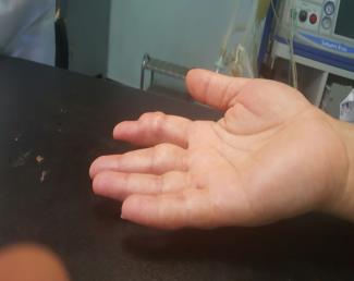 Figure 1: Clinical aspects of the giant cell tumor of the tendon sheath of the second finger.
