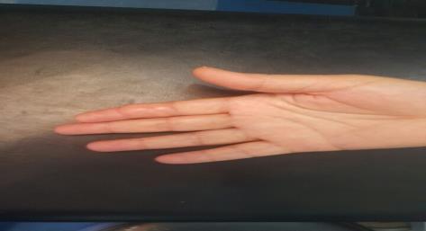 Figure 2: Per-operative image of the giant cell tumor of the tendon sheath of the second finger.