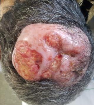 Figure 1: Exophytic tumor mass, ulcerative budding, 12 cm in major axis, on the vertex.