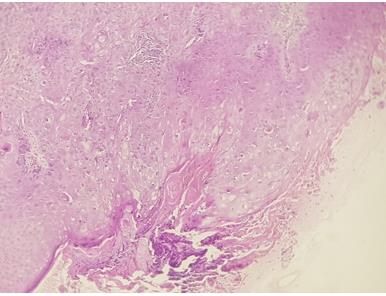 Figure 2: With very marked cyto-nuclear atypies and a fibrous infiltrated stroma squamous cell proliferation arranged in masses and coalescent lobules centered by abrupt keratinization.