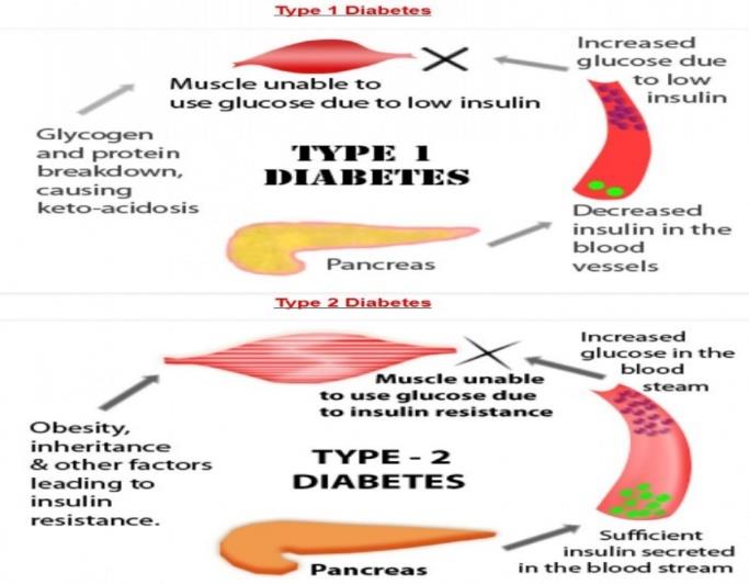Figure 1: Type-1 and type-2 diabetes mellitus.