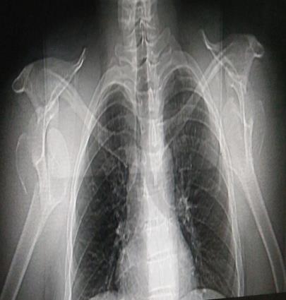 Figure 2: Standard radiographic image showing anterior dislocation of both shoulders with bilateral fracture of the greater tuberosity.
