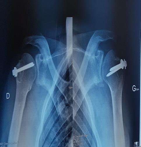 Figure 3: Standard radiograph of the patient's two shoulders after 08 weeks postoperatively showing the consolidation of the greater tuberosity.