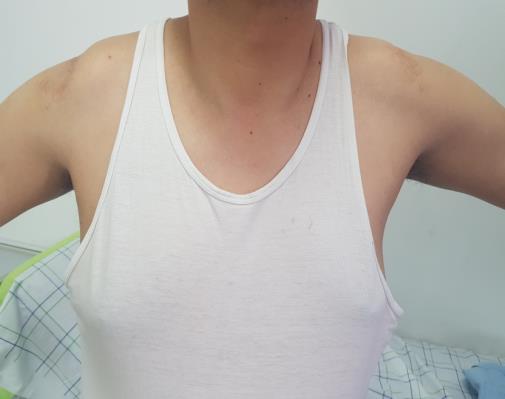 Figure 4: Photo of the patient with a good functional evolution of his shoulders.