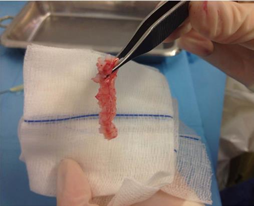 Figure 4: The diced cartilage carried in the PRP clot before being wrapped in the fascia graft.