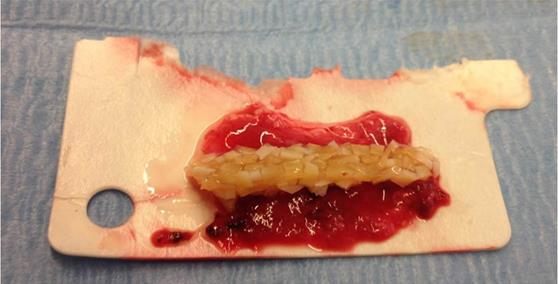 Figure 9: Once the chrysalis is rolled, the PPP was sprayed over it to act as fibrin glue avoiding the use of stitches.