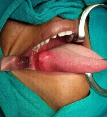 Figure 1: Pre operative picture showing mucosal lined swelling on lateral border of tongue right side.