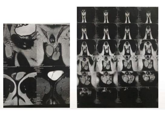 Figure 1: Preoperative MRI: Extratesticular mass that is slightly hypointense relative to testicular parenchyma on T2-weighted images and usually does not enhance more intensely than the testis on contrast-enhanced images.