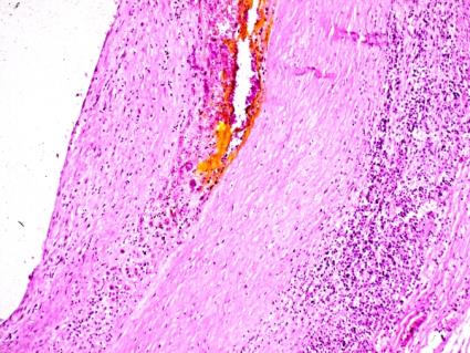 Figure 1: RA, heart, main (medium size) coronary artery, non-specific subchronic vasculitis Sectorial accentuated lympho-plasmocellular infiltration and moderate fibromuscular intimal proliferation. More than 21 days old hemorrhage, with hematoidine crystals at the border of intima and media. (a) HE, x20 (b) same as (a) x50