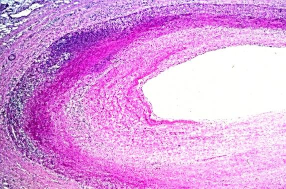 Figure 3: RA, heart, main (medium size) subepicardial coronary artery, subchronic nodular vasculitis Typical rheumatoid nodule in media and adventicia, sectorial accentuated granulomatous transformation of vessel wall and moderate fibromuscular intimal proliferation. (a) HE, x20 (b) same as (a) x50