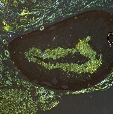 Figure 7: RA, exudative miliary epithelioid granulomas in atrophic suprarenal gland (a) HE, x 50, (b) same as (a) x125