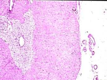Figure 9: RA, lung, undifferentiated bronchoalveolar carcinoma Irregular spaces separated by fibrotic septa, and enveloped by tall columnar epithelium. (a) HE, x 40, (b) same as (a) x100, (c) Anti-human epithelial membrane antigen (mono/DAKO N1504), x 100, (d) Anti- human carcinoembrionic antigen 1:100 (mono/DAKO N1503) x100