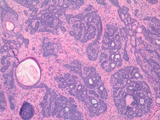 Figure 1: Trichoblastoma Composites of Basaloid Epithelium with Predominantly Fibrotic Stroma [18].
