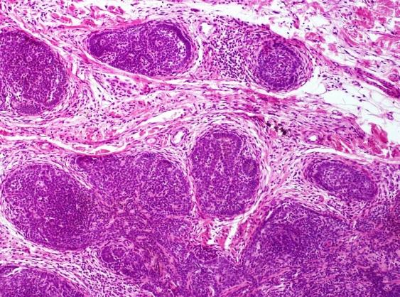 Figure 10: Trichoblastoma with Adenoid Clusters of Basaloid Cells and Thin, Superimposed Epithelium [24].