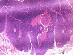 Figure 11: Trichoblastoma with Uniform Cellular Congruence and Fibrocellular Stroma [25].