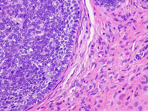 Figure 3: Trichoblastoma with Peripheral Palisade of Basaloid Cells Devoid of Atypia [20].