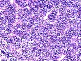 Figure 5: Trichoblastoma with Basaloid Cell Composites and Minimal Cellular Atypia [21].