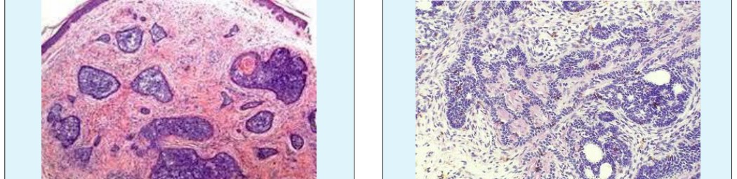 Figure 7: Pigmented Trichoblastoma with Deposits of Melanin within Basaloid Composites [22].