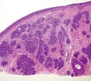 Figure 9: Trichoblastoma with a Lace like Configuration of Epithelial Cells and Ample Fibroblastic Stroma [24].