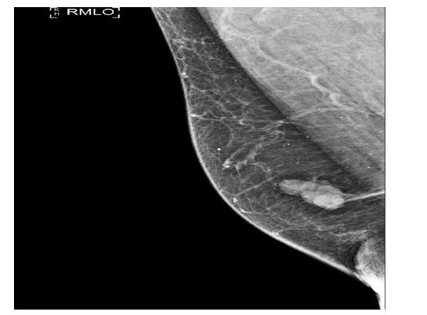 Figure 1: MLO view of right breast demonstrates an irregular high-density mass with microlobuated margins eccentric to the nipple.