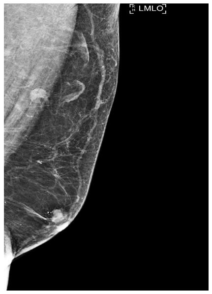 Figure 2: MLO view of left breast demonstrates an irregular high-density mass with microlobuated margins in a subareolar location. Normal appearing lymph nodes are seen in the axilla.