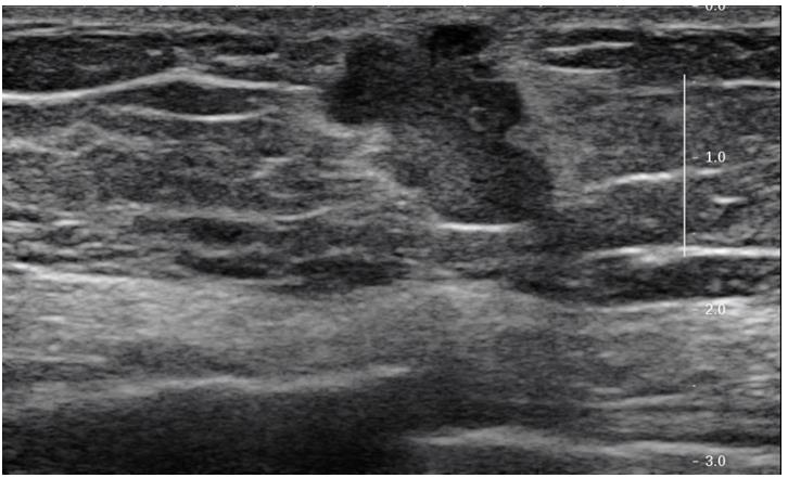 Figure 3: Grayscale ultrasound image of the right breast demonstrates a subareolar taller than wide irregular hypoechoic mass with lobular and angular margins.