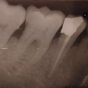 Figure 2: Showing immediate post-operative picture. Marked radiolucency visible in periapical area.
