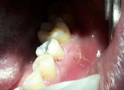Figure 3: At 3 months follow up. Bone healing is evident radiographically and normal healing clinically.