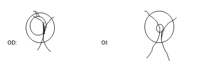 Figure 1: RE & LE. Pupillary Reflections: Preserved in both eyes. Primary look position: Orthophoria both eyes. Eye movements: No limitations.