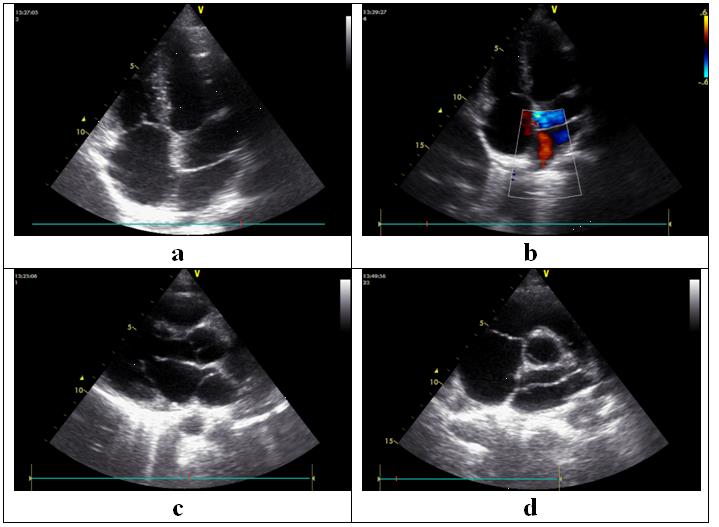 Figure 1: a. Apical 4 chamber view, b. Apical 4 chamber view with color Doppler, c. Parasternal long axis view, d. Parasternal short axis view - showing components of cor triatriatum.