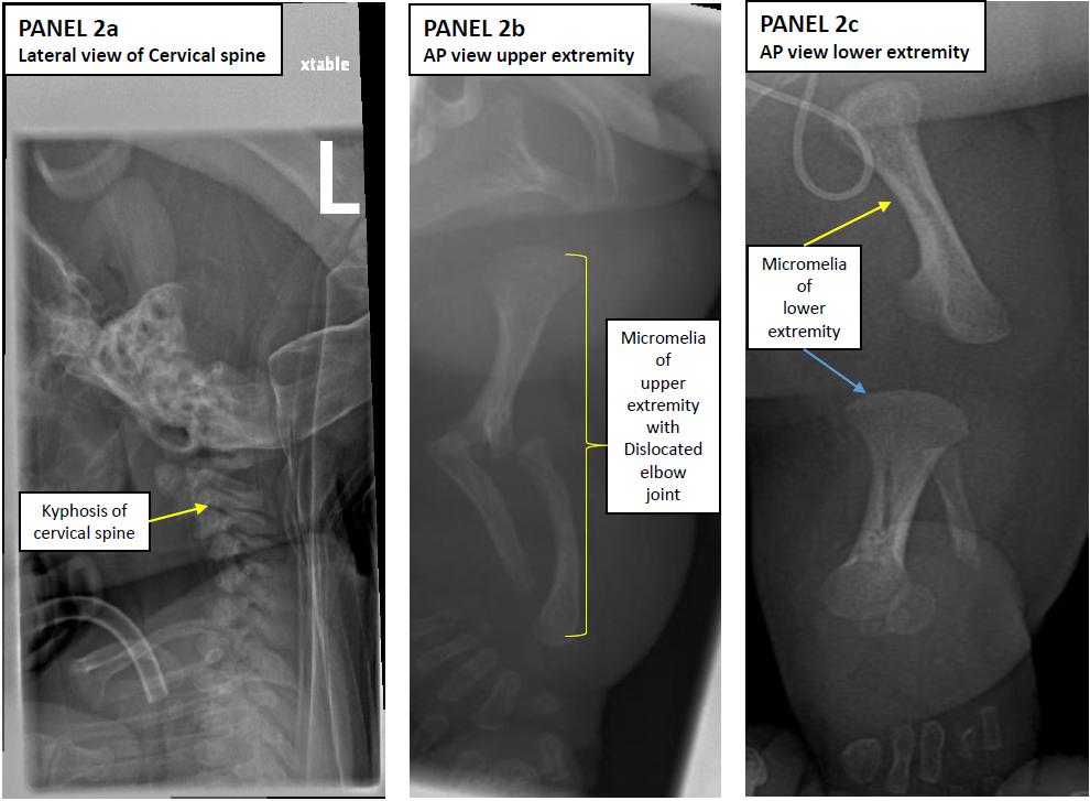 Figure 2: Kyphosis of cervical spine, Micromelia of upper and lower extremity.