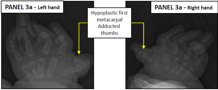 Figure 3: Hypoplastic first metacarpal Adducted thumbs.