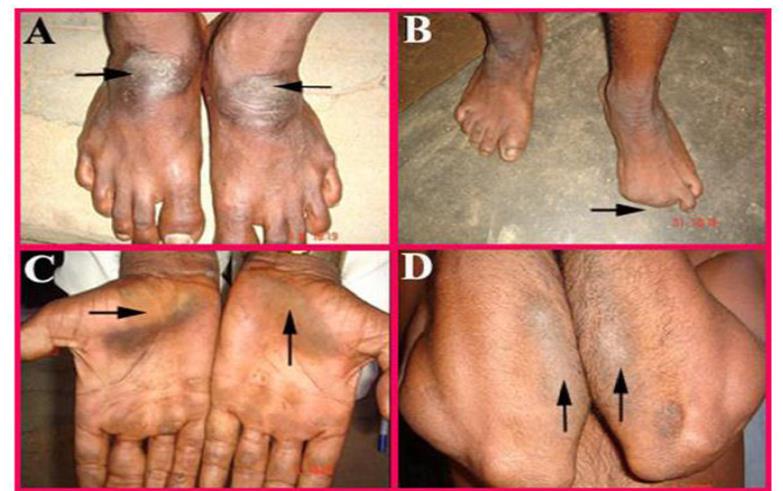 Figure 1: The ill effect on the feet & hands of the coconut palm climber, George, et al. [2].