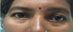 Figure 2: Post-Operative Day 30.